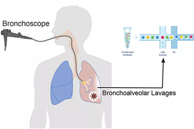 Immune atlas of COVID-19 Bronchoalveolar Lavages