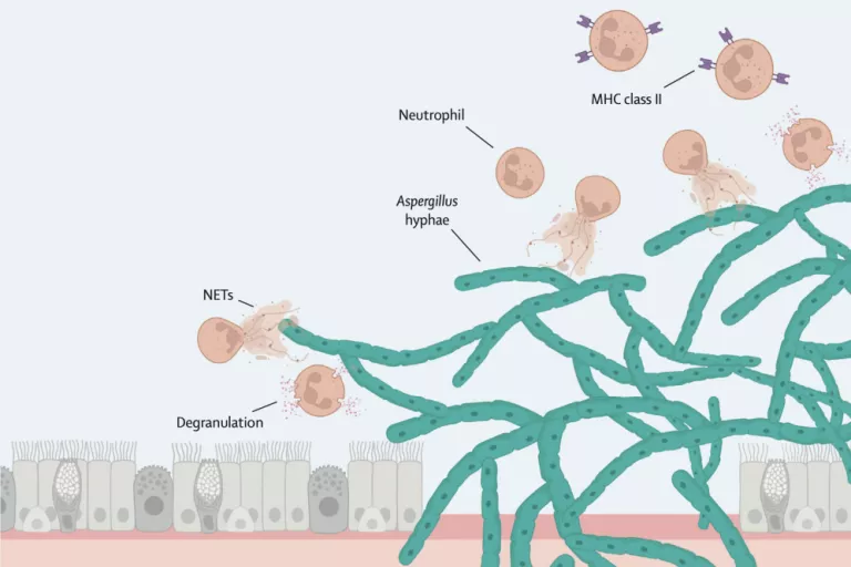 COVID-19-associated pulmonary aspergillosis